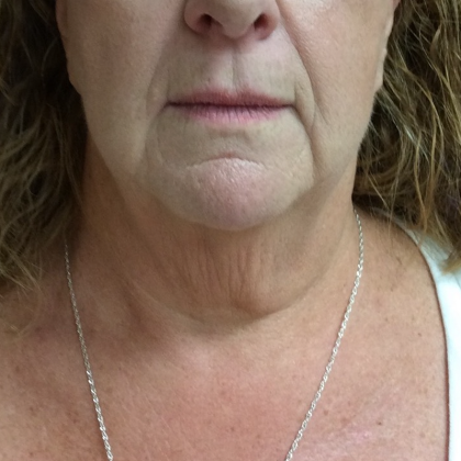 Neck Lift Before & After Patient #9723