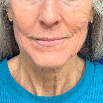 Neck Lift Before & After Patient #9731
