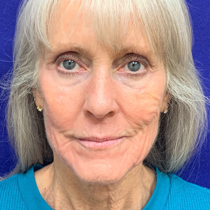 Mini Facelift Before & After Patient #9734