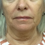 Neck Liposuction Before & After Patient #9737