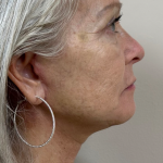 HourLift Before & After Patient #9742