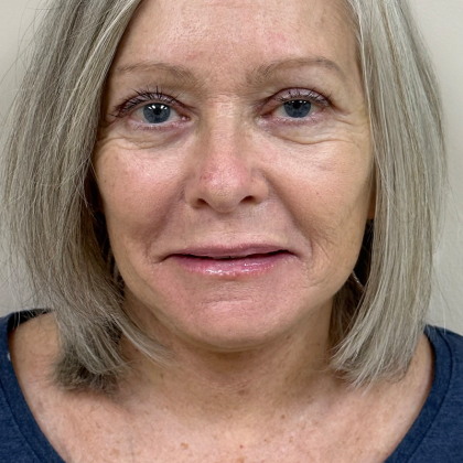 HourLift Before & After Patient #9742