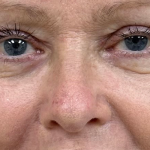 Blepharoplasty Before & After Patient #9747