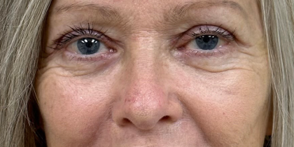 Blepharoplasty Before & After Patient #9747