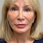 HourLift Before & After Patient #9753