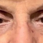 Blepharoplasty Before & After Patient #9630