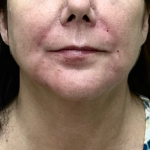 Neck Lift Before & After Patient #9766
