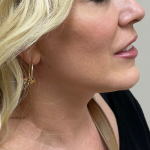 Neck Liposuction Before & After Patient #9772