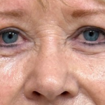Blepharoplasty Before & After Patient #9779