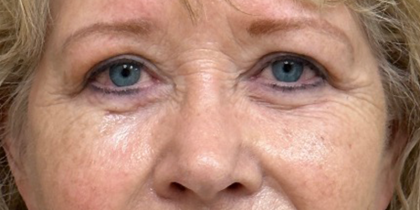 Blepharoplasty Before & After Patient #9779