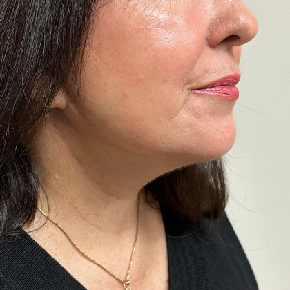 Neck Lift Before & After Patient #9652