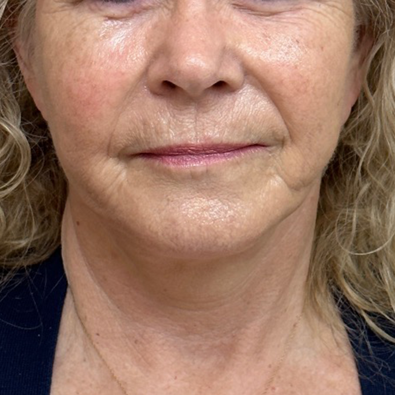 Neck Lift Before & After Patient #9801