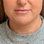 Neck Lift Before & After Patient #9885