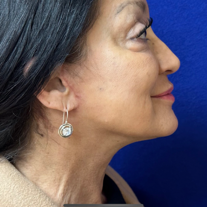 HourLift Before & After Patient #9909