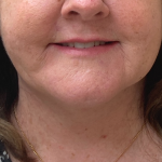 Neck Lift Before & After Patient #9716