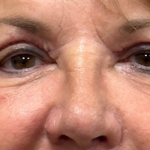 Blepharoplasty Before & After Patient #9913