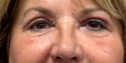 Blepharoplasty Before & After Patient #9913