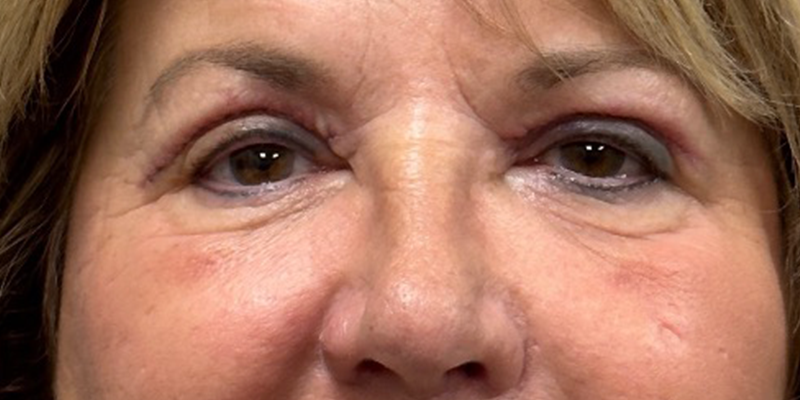 Blepharoplasty Before & After Patient #9913