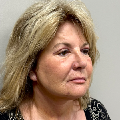 Facelift Before & After Patient #9924