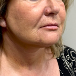 Neck Lift Before & After Patient #9929