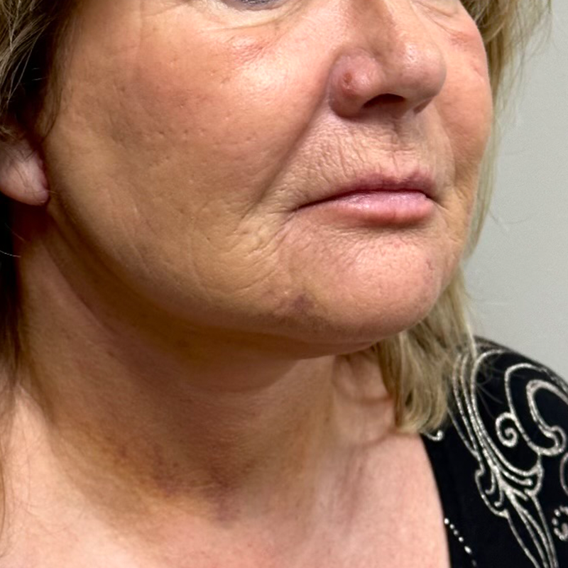 Neck Lift Before & After Patient #9929