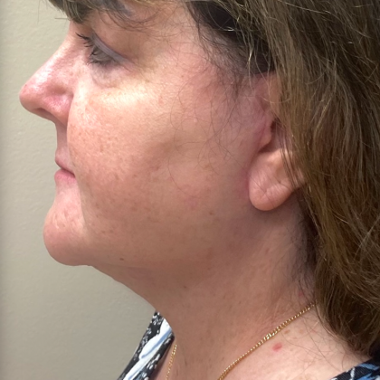 Neck Lift Before & After Patient #9720