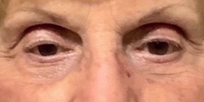 Blepharoplasty Before & After Patient #9630