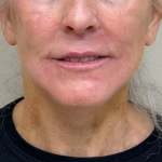 Neck Lift Before & After Patient #9731