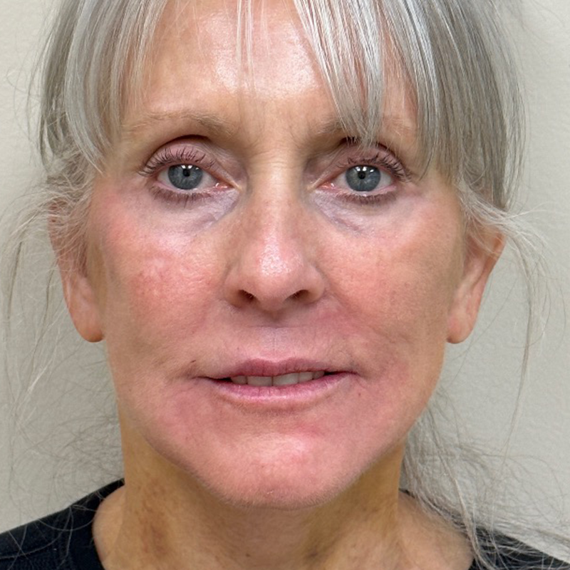 HourLift Before & After Patient #9734