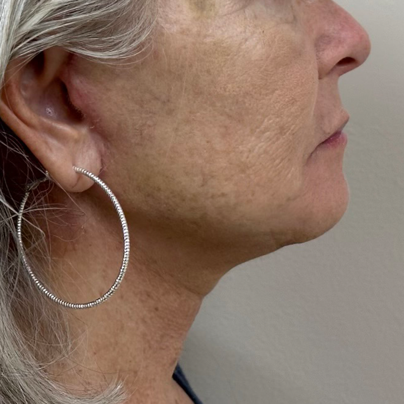 Neck Liposuction Before & After Patient #9737