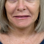 Neck Liposuction Before & After Patient #9737
