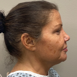 HourLift Before & After Patient #9932