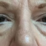 Blepharoplasty Before & After Patient #9622