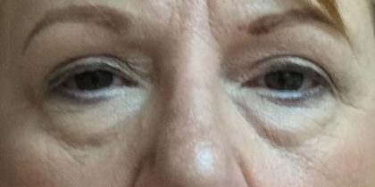 Blepharoplasty Before & After Patient #9622