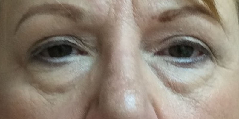 Blepharoplasty Before & After Patient #9622
