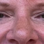 Blepharoplasty Before & After Patient #9622
