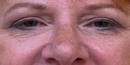 Blepharoplasty Before & After Patient #9622