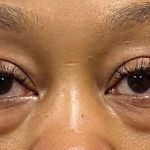 Blepharoplasty Before & After Patient #9618