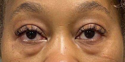 Blepharoplasty Before & After Patient #9618