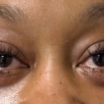 Blepharoplasty Before & After Patient #9618