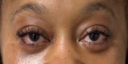 Blepharoplasty Before & After Patient #9618