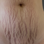 Morpheus8 Before & After Patient #9916