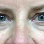 Blepharoplasty Before & After Patient #9627