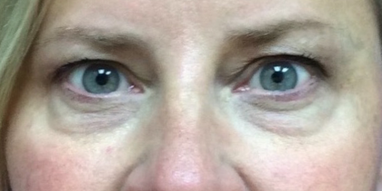 Blepharoplasty Before & After Patient #9627