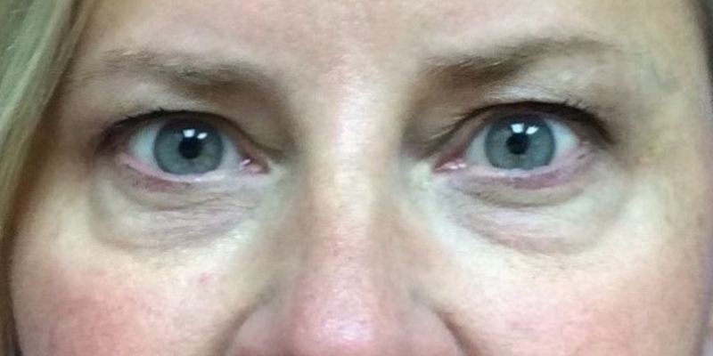 Blepharoplasty Before & After Patient #9627