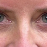 Blepharoplasty Before & After Patient #9627