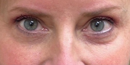 Blepharoplasty Before & After Patient #9627