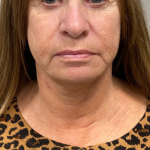 Neck Lift Before & After Patient #9950