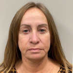 HourLift Before & After Patient #9949