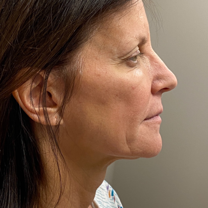 HourLift Before & After Patient #9988